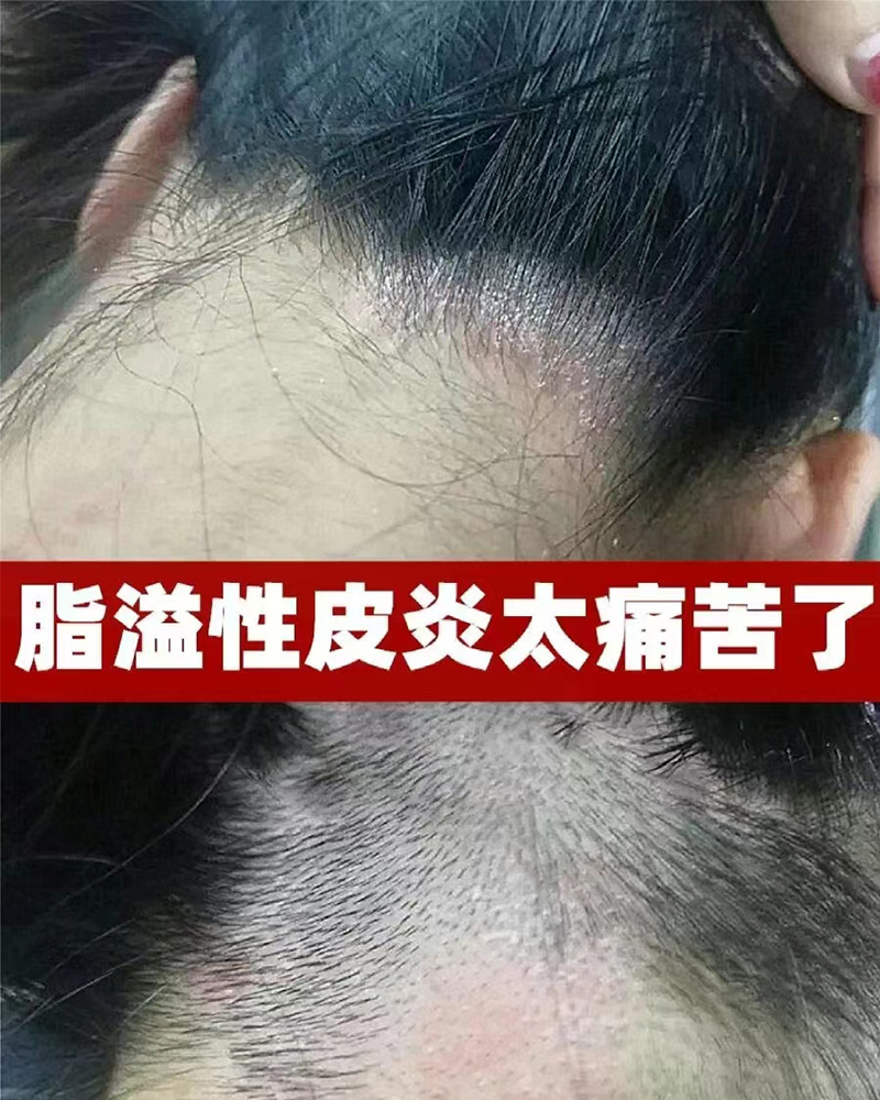 头屑多头皮痒,怎么治疗