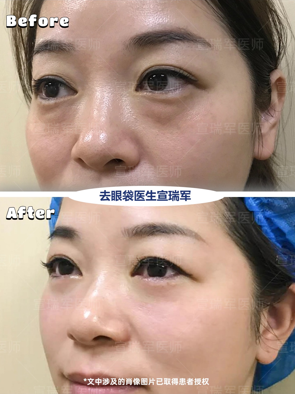 去除眼袋手术