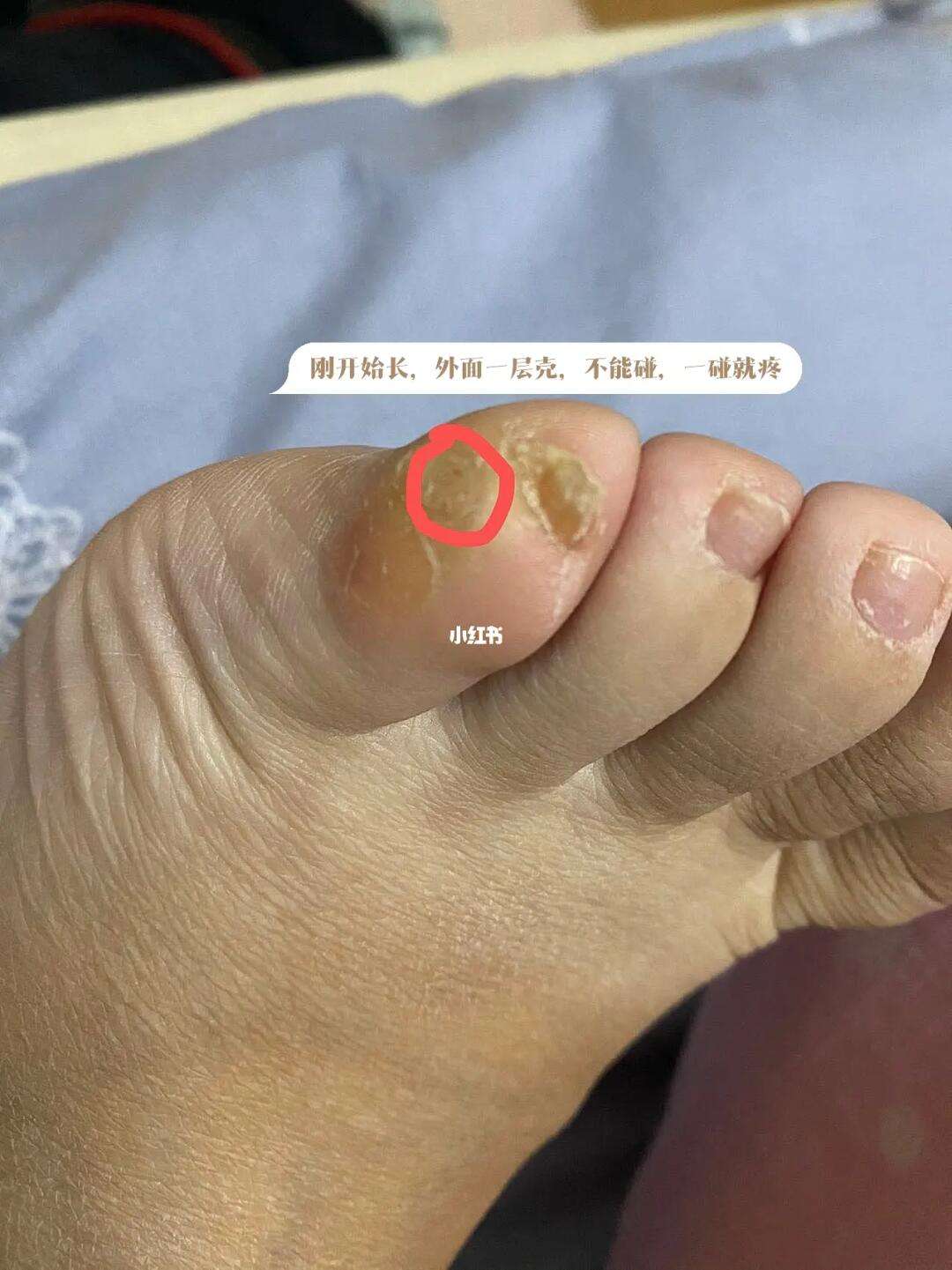 脚上长鸡眼是什么原因