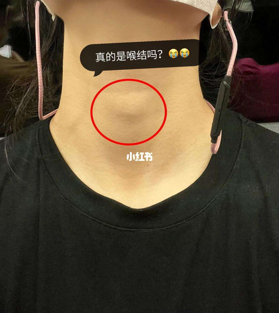 喉结大是病吗?
