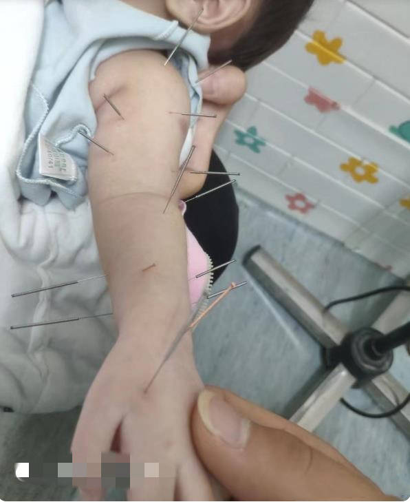 新生儿臂丛神经损伤的原因有哪些?