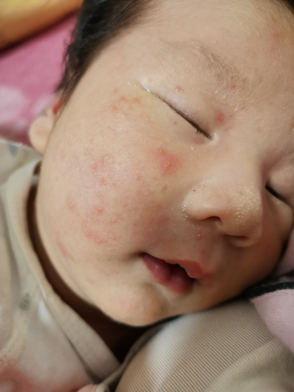 婴儿痤疮最佳治疗方法有哪些