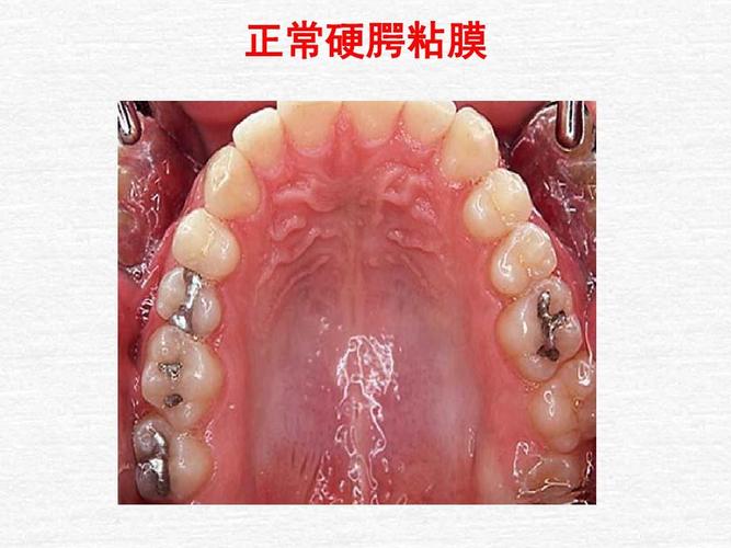 三个多月的宝宝口腔上颚发白