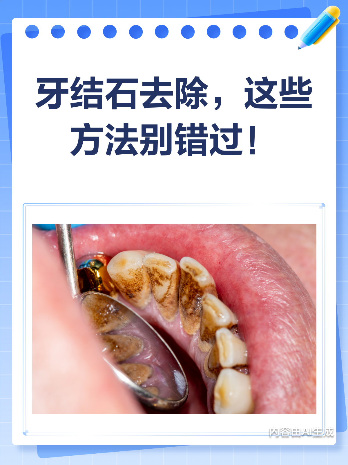 牙齿上有牙结石怎么办