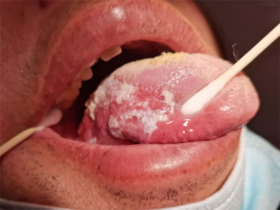 口腔黏膜白斑会自愈吗