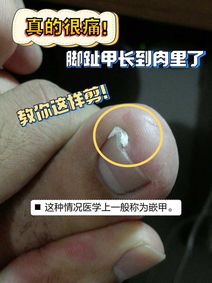 嵌甲怎么根治?