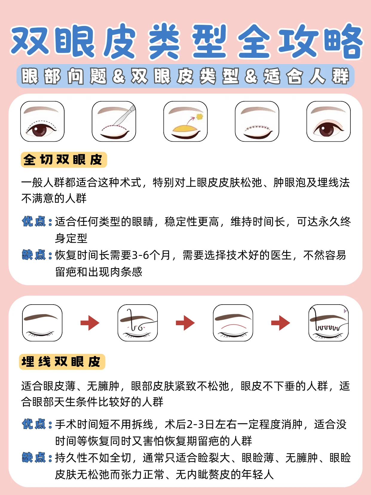 怎么割双眼皮?