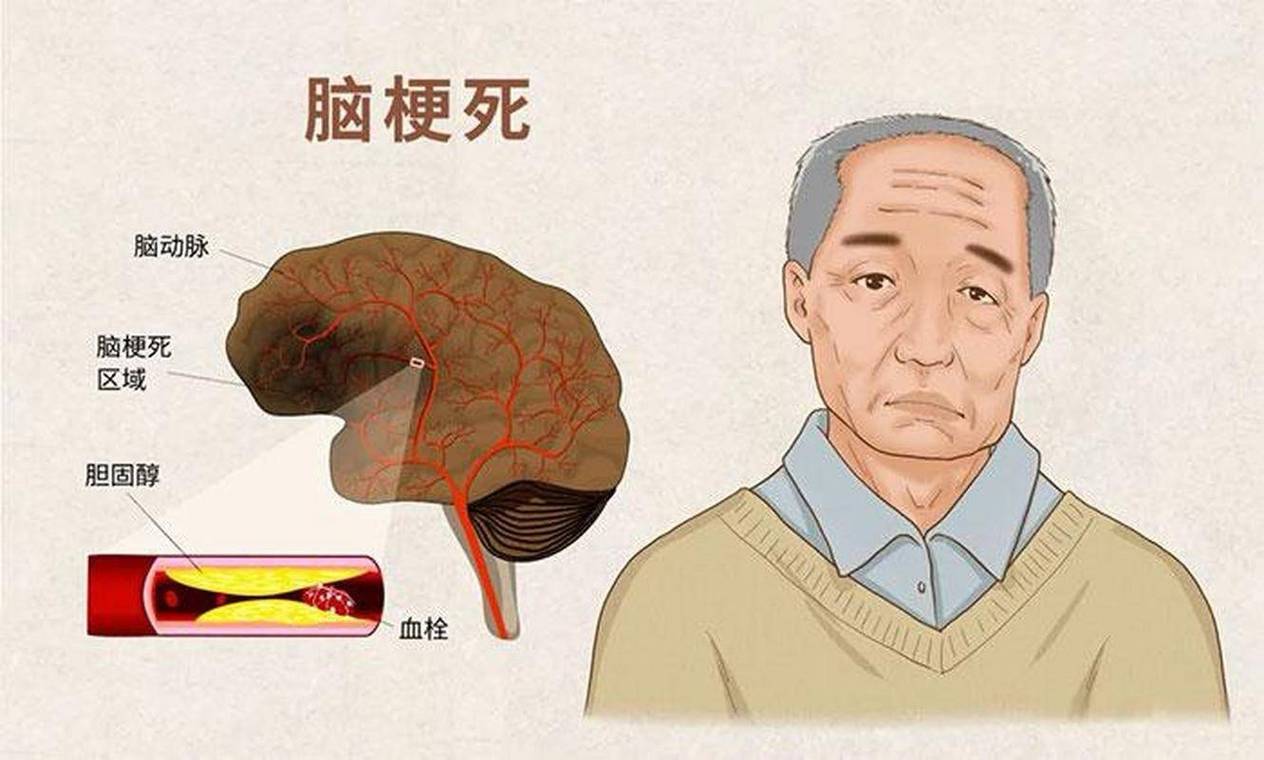 脑梗的前兆