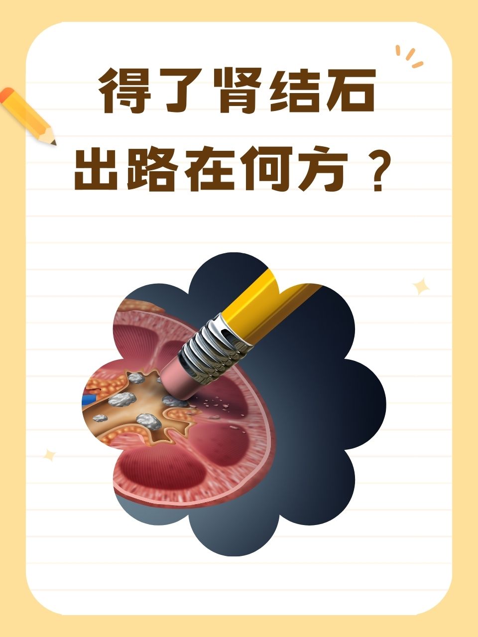 人为什么会得肾结石呢?