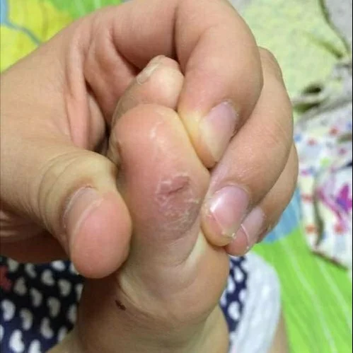 小孩手脚脱皮怎么回事