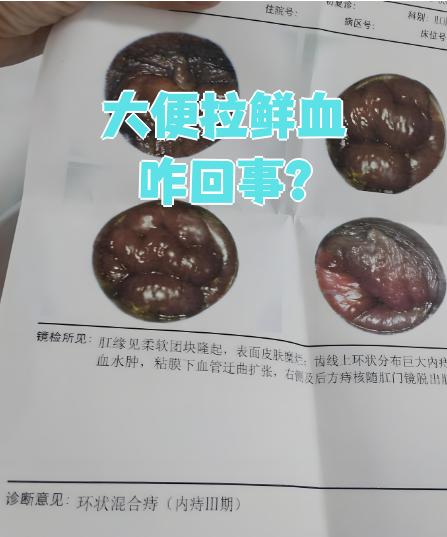有时大便出血是什么原因?