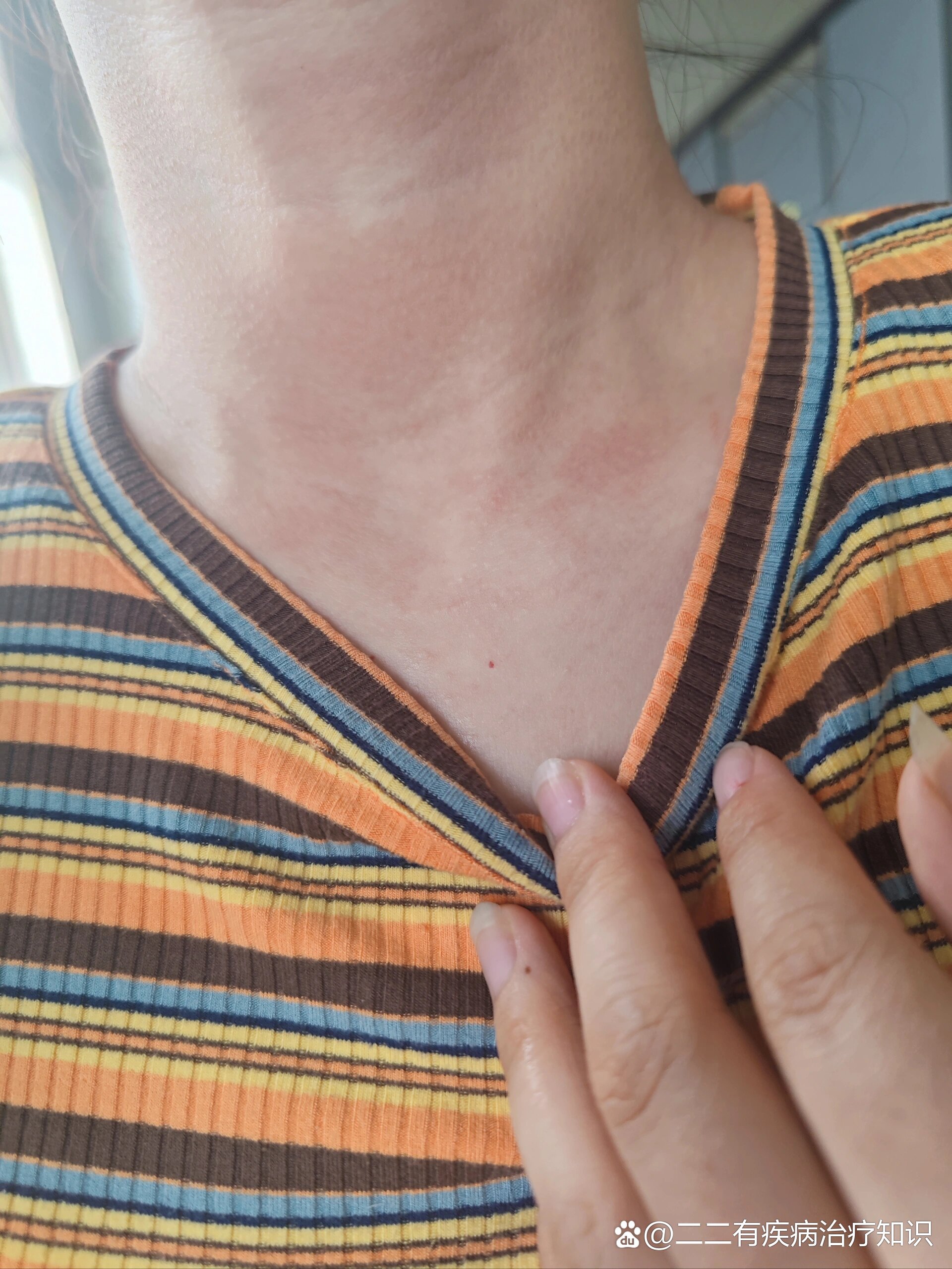 大脖子病是什么症状?