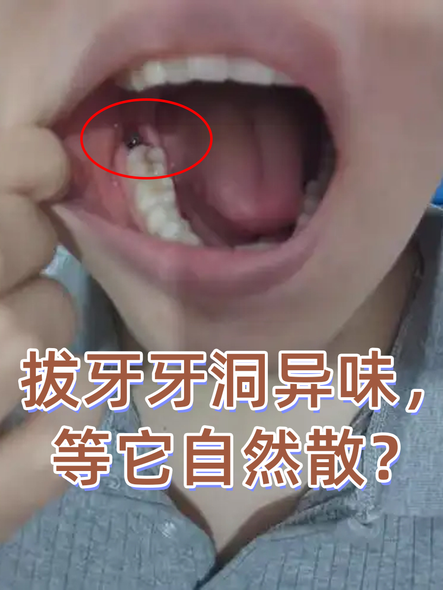 牙齿有洞怎么办