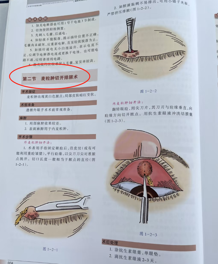 内麦粒肿一定要手术吗