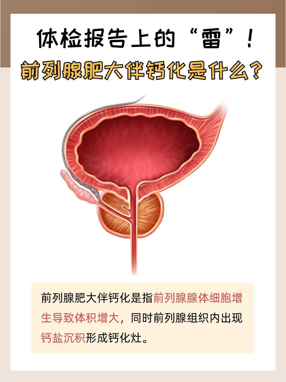 年轻人会不会得前列腺钙化灶?