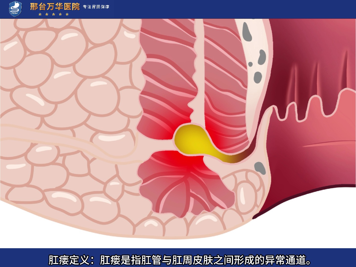 什么是高位肛瘘?