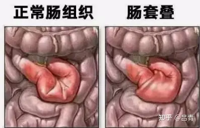肠套叠主要临床表现