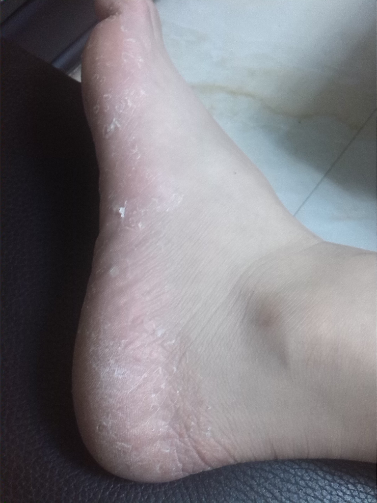 脚脱皮是脚气吗