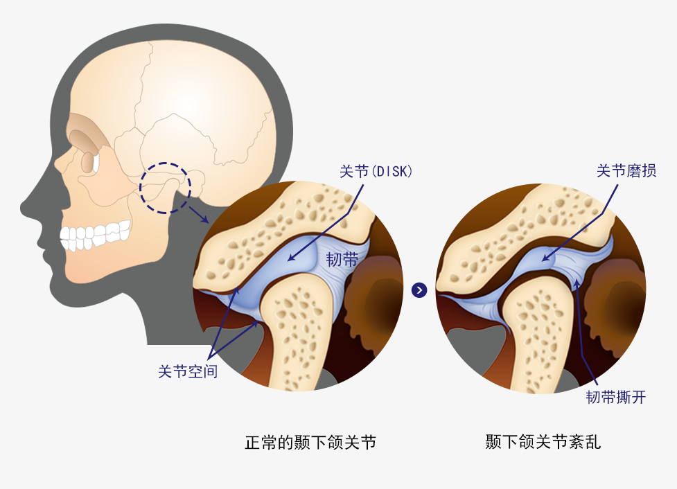 下颌关节炎怎么治?