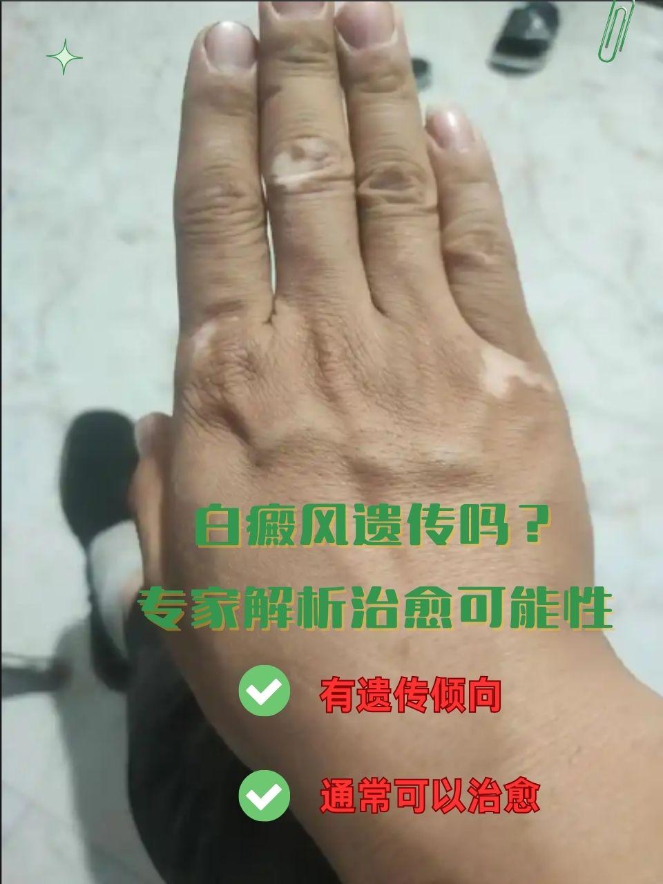 色素脱失怎么治疗?