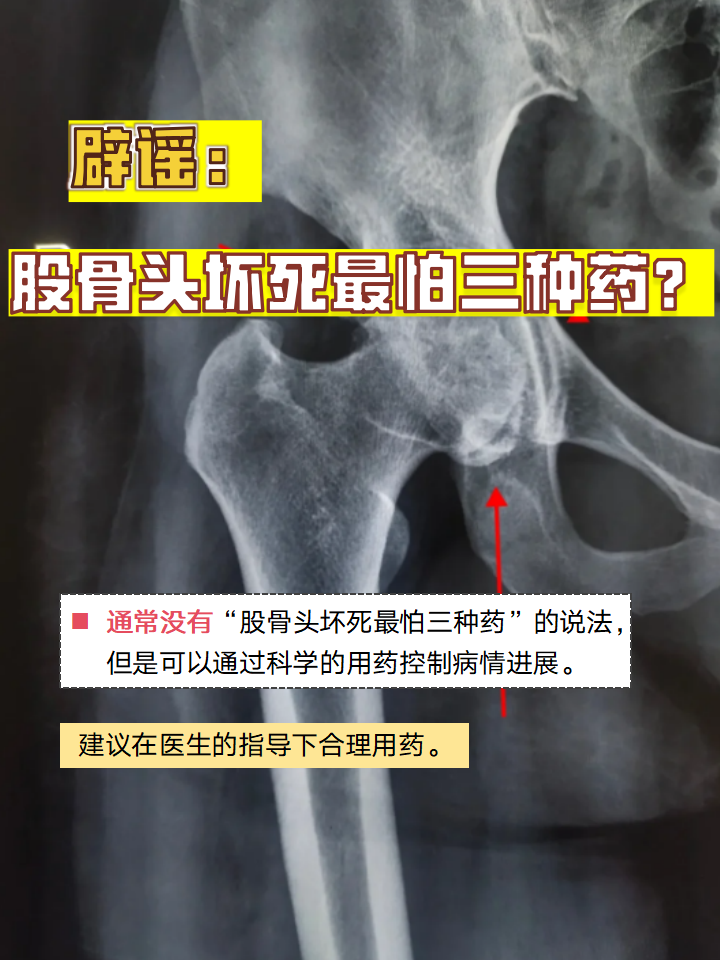 股骨头坏死的鉴别诊断