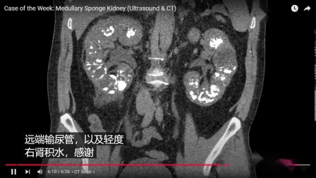 什么是海绵肾