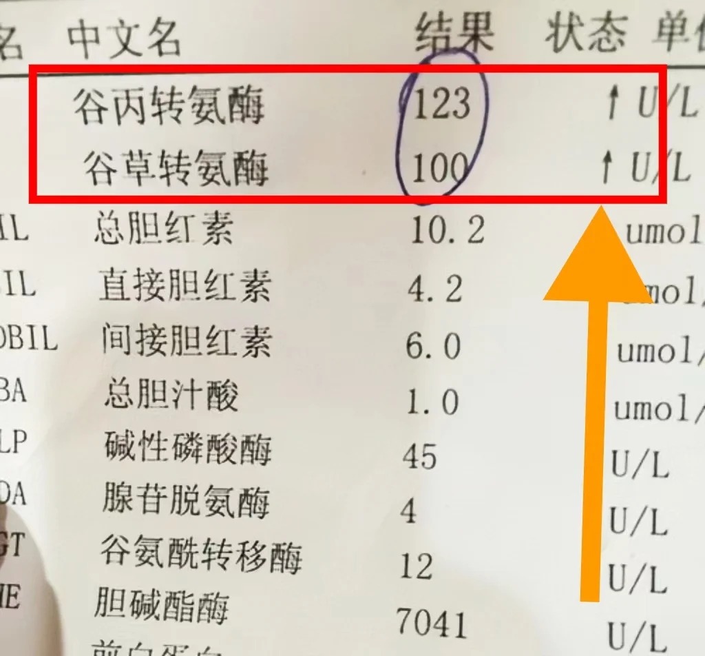 丙氨酸转氨酶偏高是什么原因?