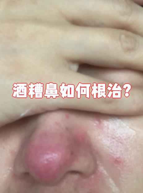 酒糟鼻能完全治疗吗?