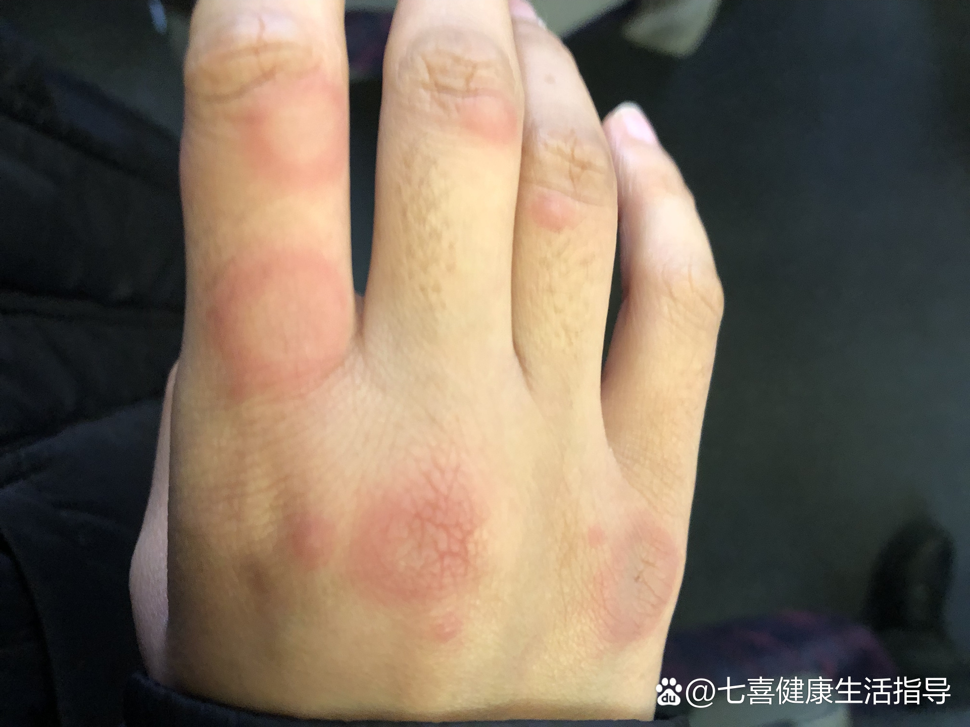 遗传性球形红细胞增多症的症状