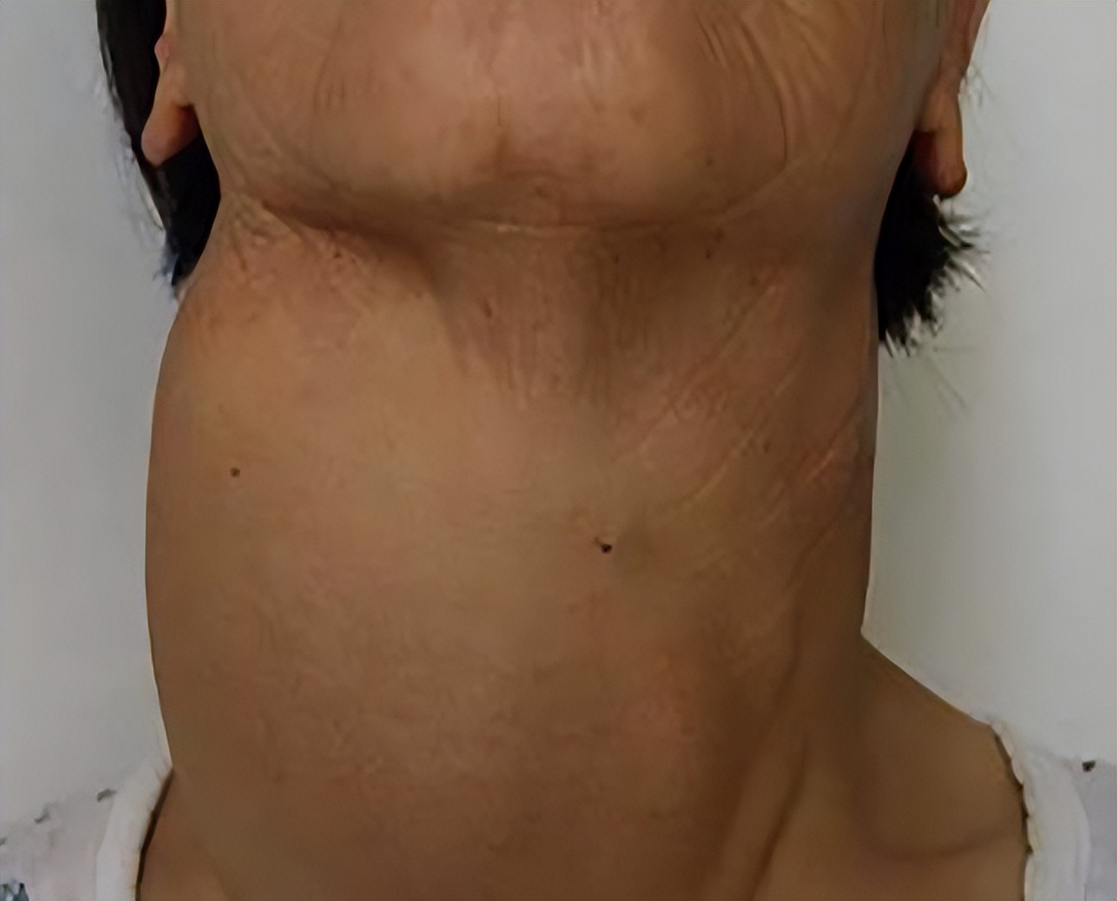 甲状腺疾病症状有哪些