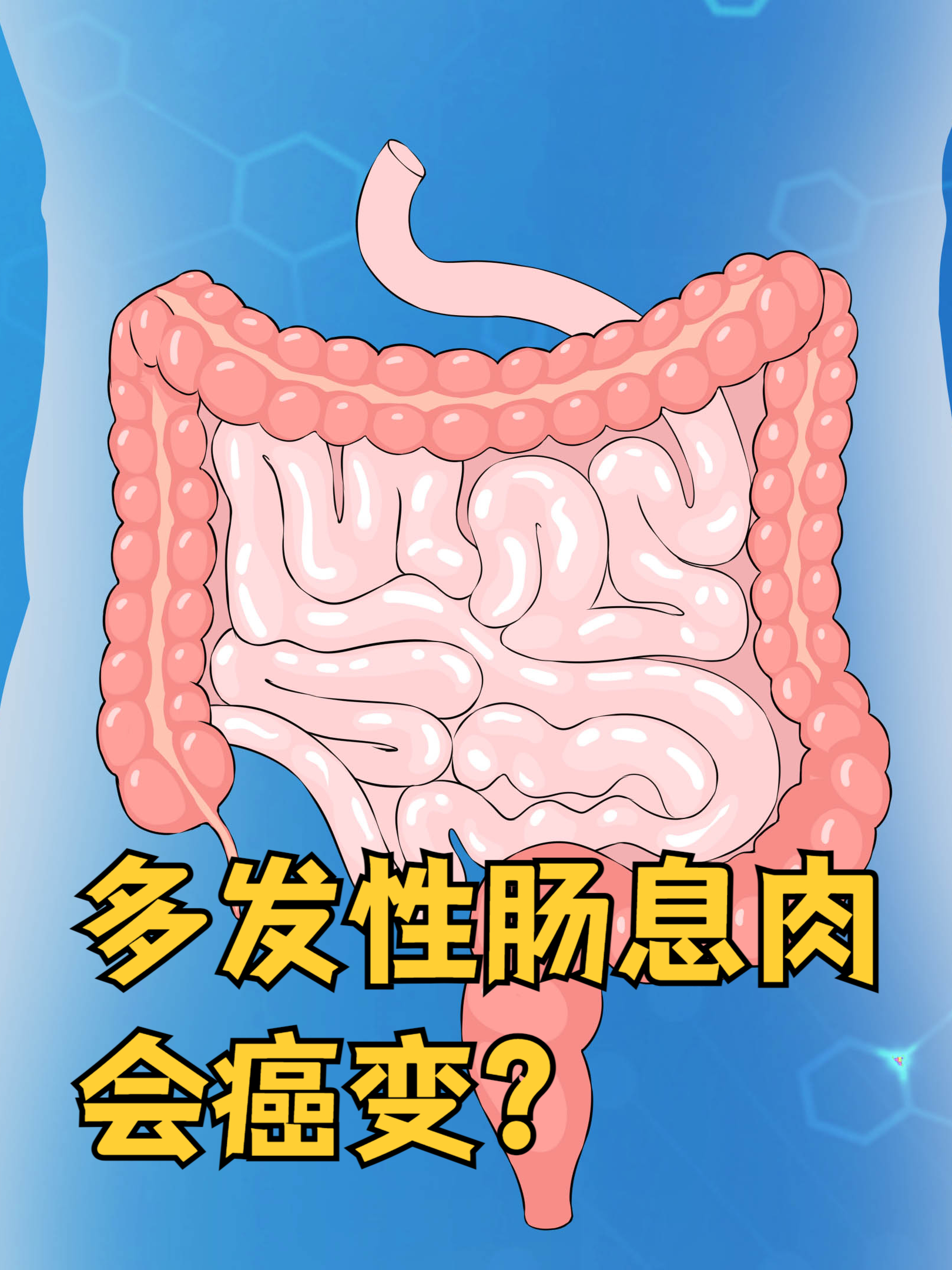 息肉会会不会癌变