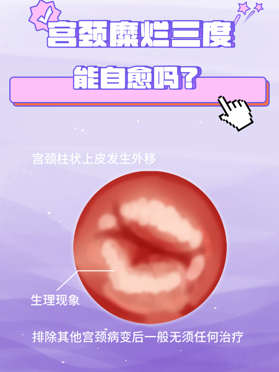 怎样治疗宫颈糜烂