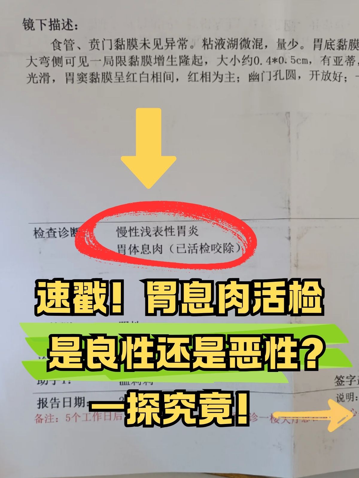 胃息肉是癌症的早期表现吗?