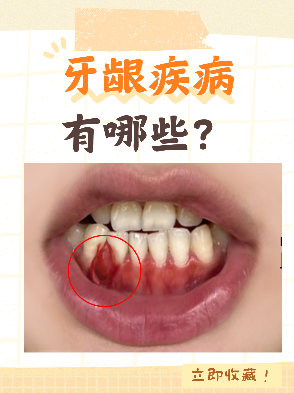 牙龈出血的疾病征兆