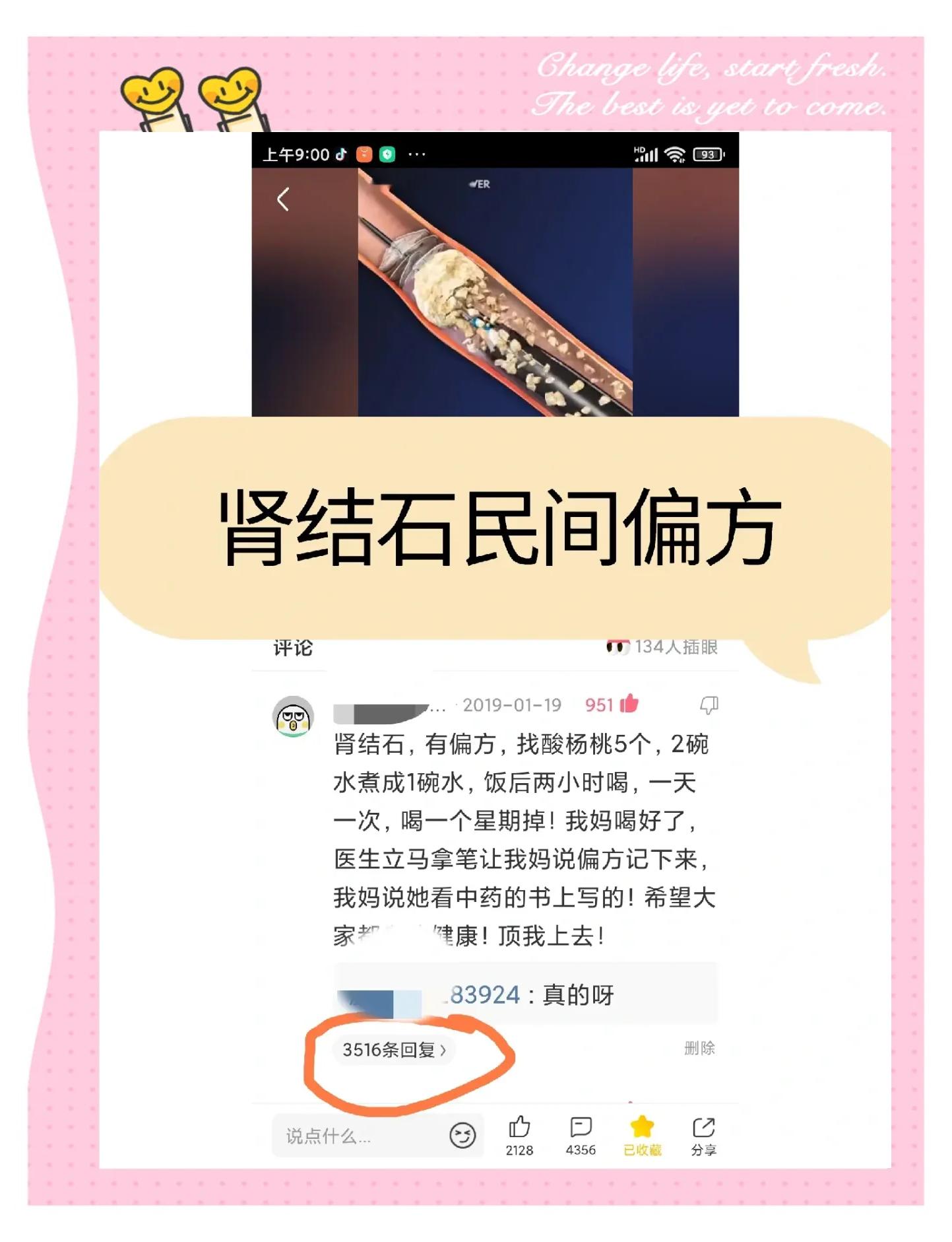肾结石最好的治疗方法