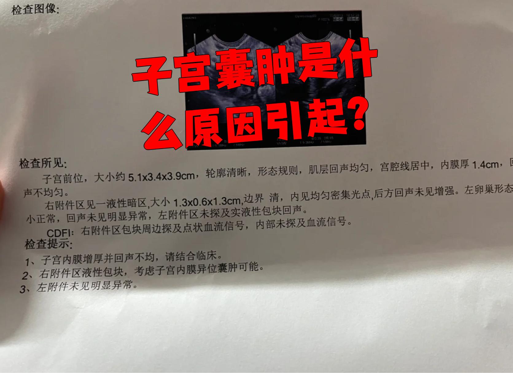 右侧附件区囊肿怎么回事?