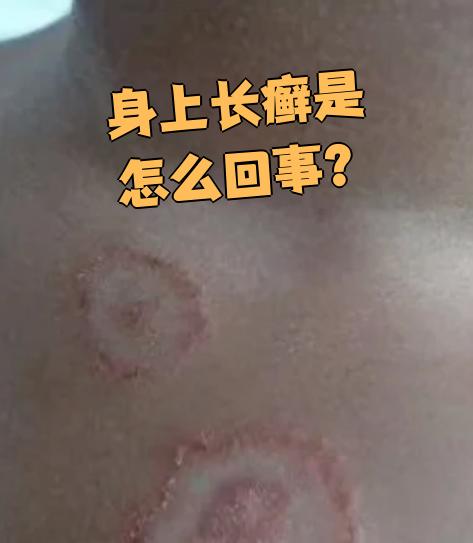 儿童牛皮癣是怎样引起的