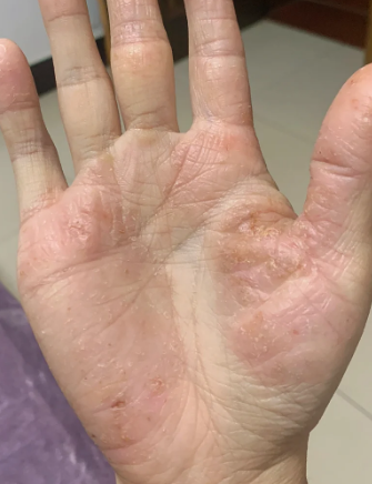 手心热脚心热是怎么回事