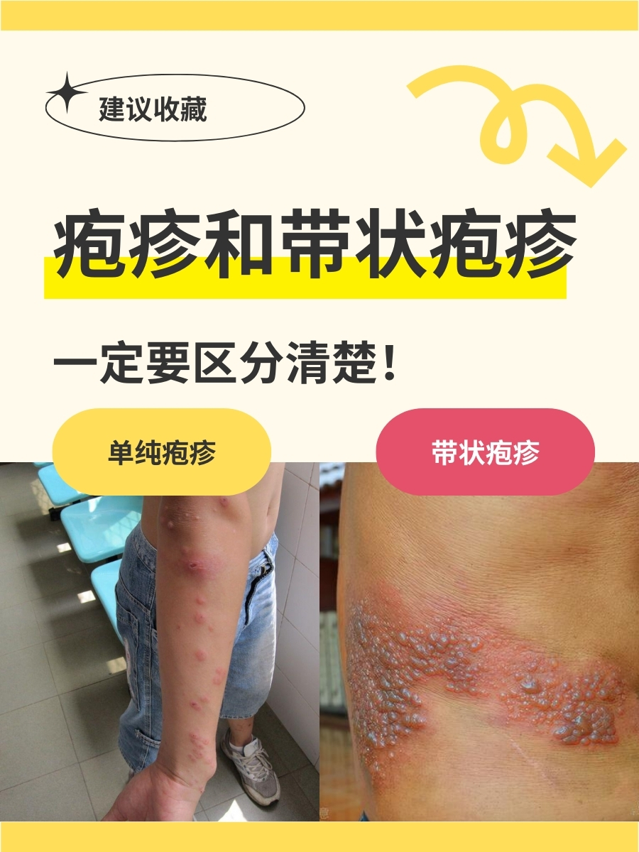 单纯疱疹如何彻底治疗
