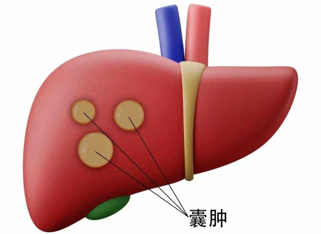肝子上有囊肿严重吗
