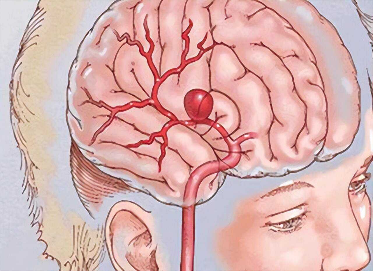 脑动脉硬化症状