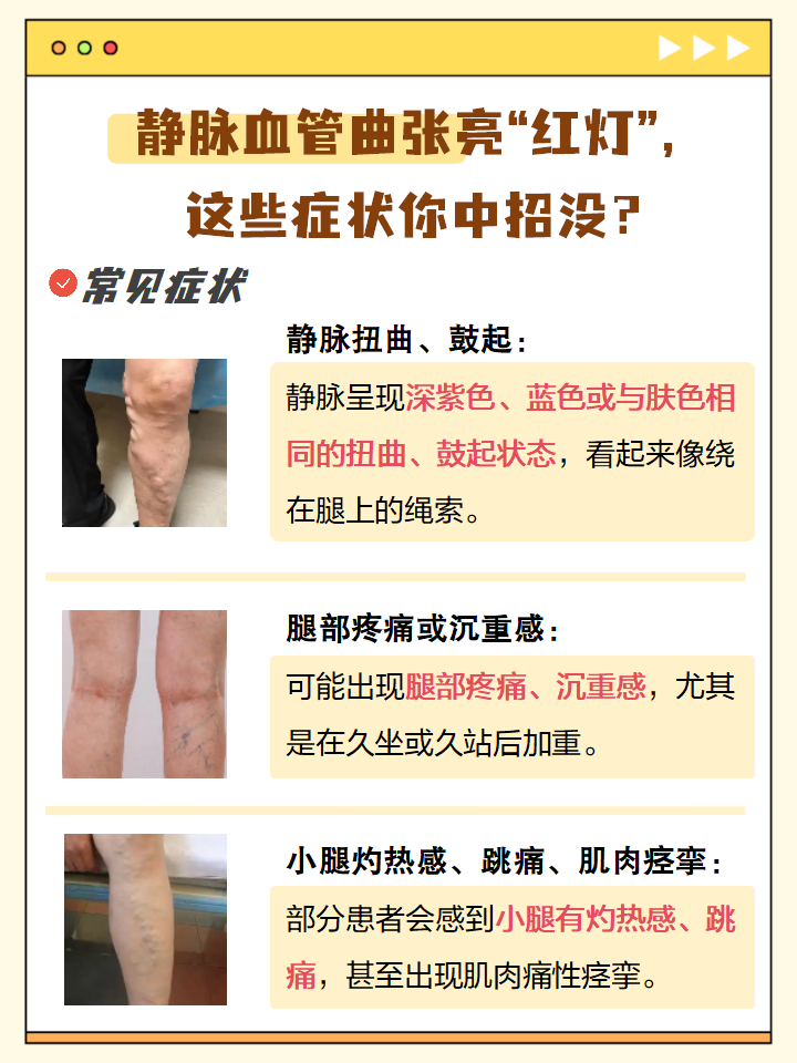 腿部静脉曲张是怎么回事