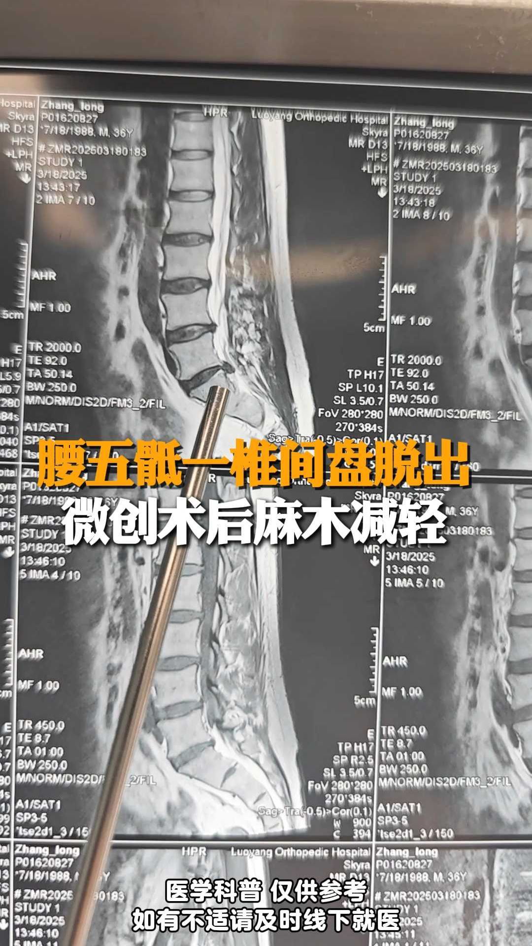 腰麻术后的后遗症有哪些?