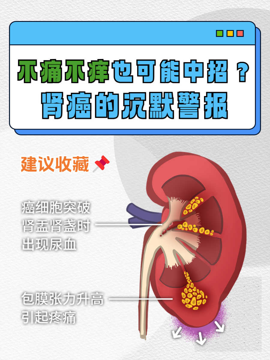 肾癌晚期症状都有什么?