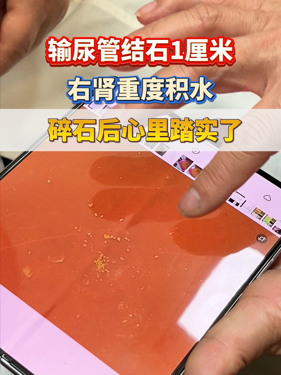 肾结石积水是怎么回事