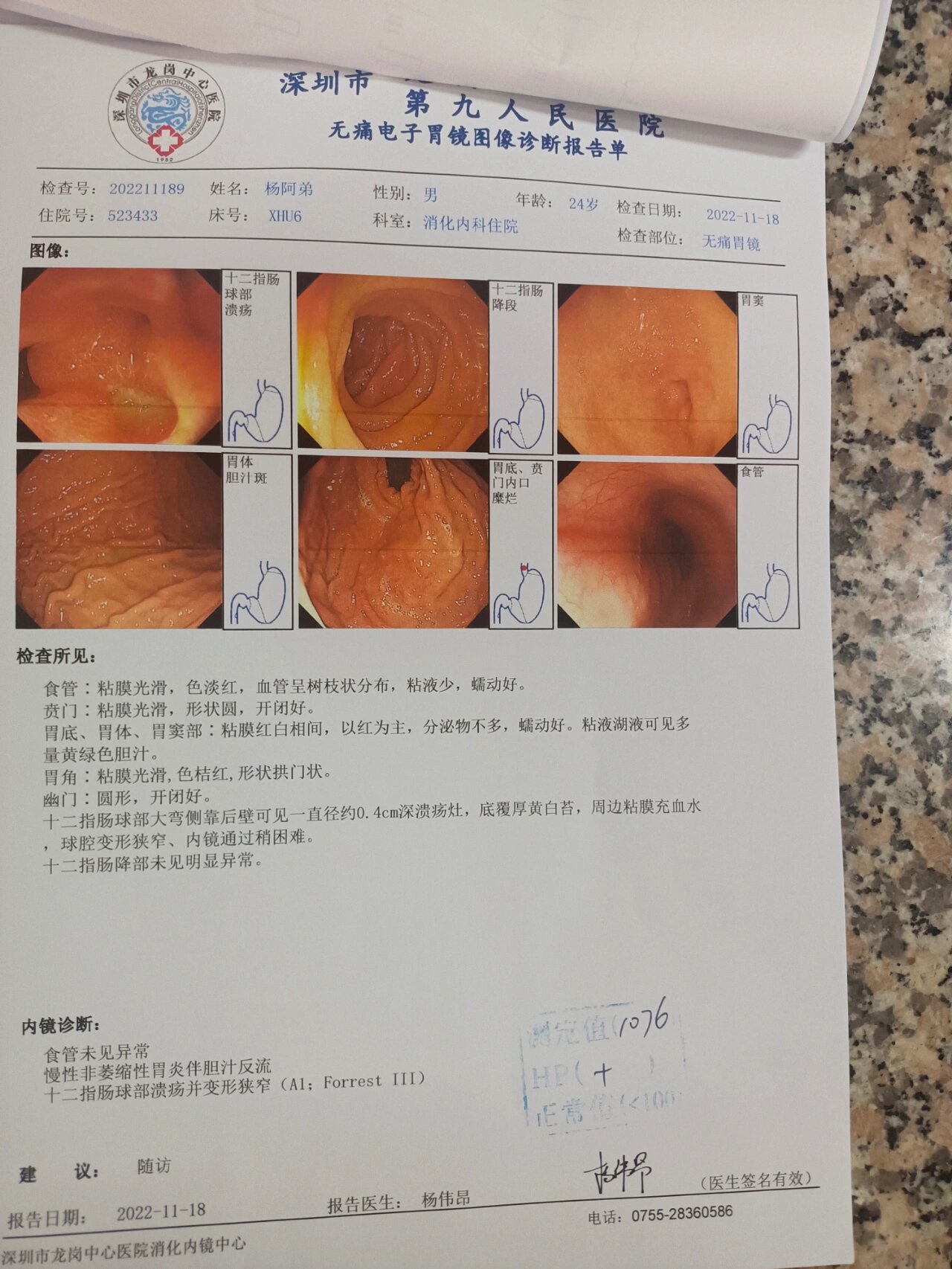 十二指肠球部溃疡a2期是什么意思