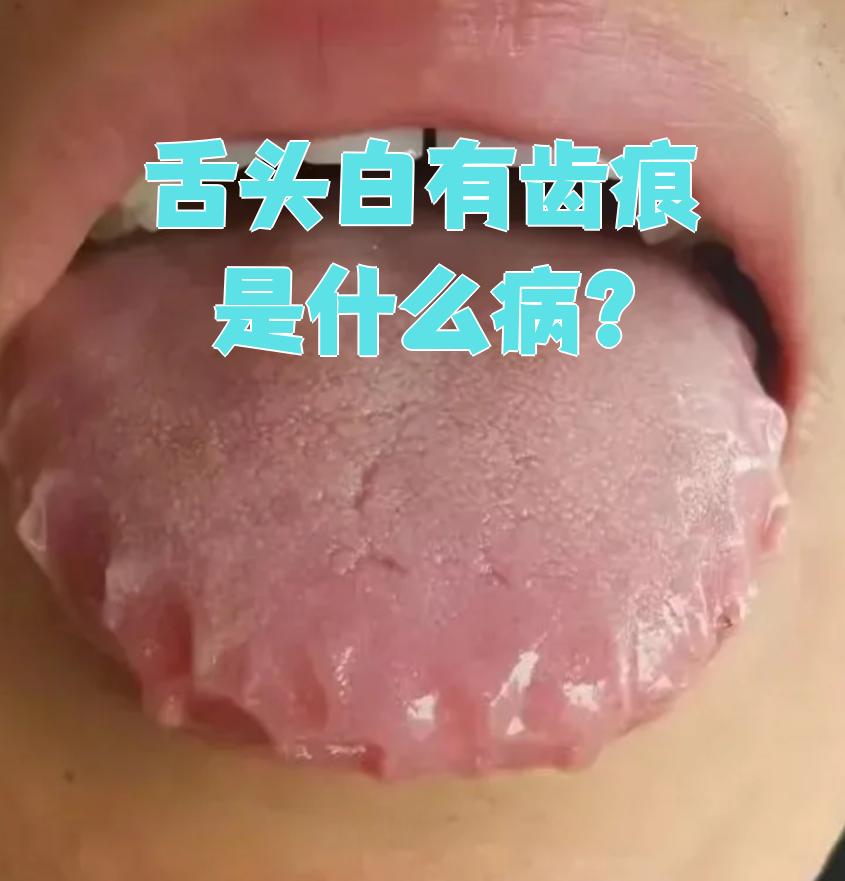 舌头两边有齿痕是什么原因?