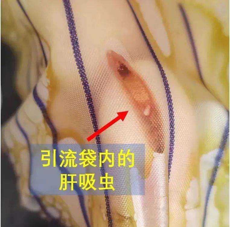 肝吸虫的症状,危害及治疗方法
