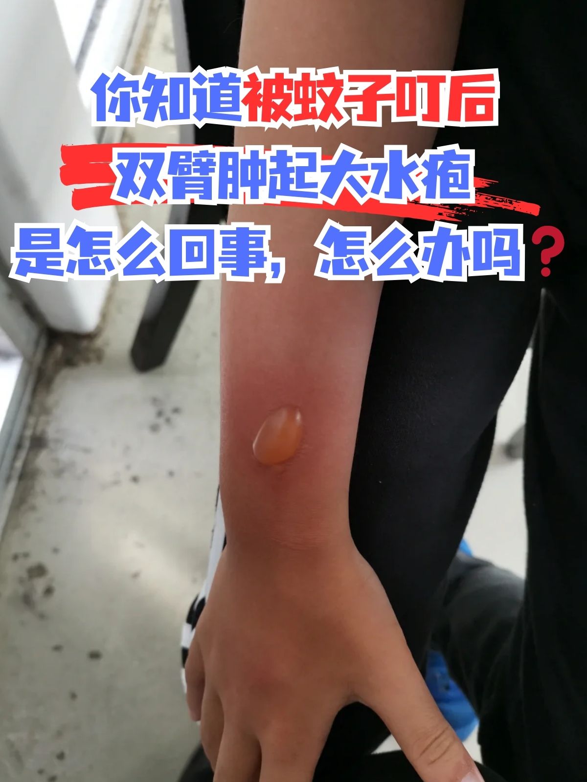 被蚊子叮咬后起硬疙瘩.