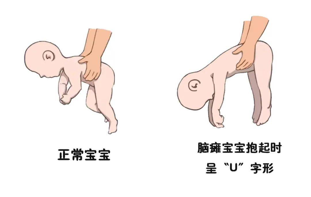 宝宝脑瘫的症状有哪些